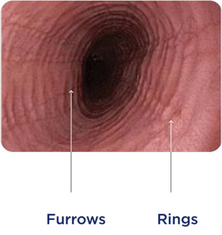 Endoscopic view of the esophagus showing esophageal furrows and rings