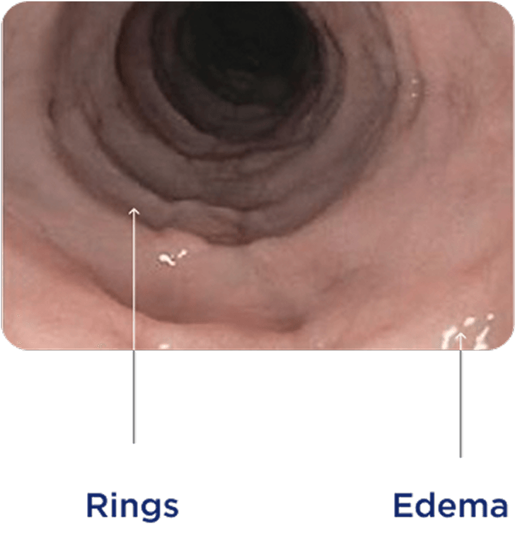 Endoscopic view of the esophagus showing esophageal rings and present edema