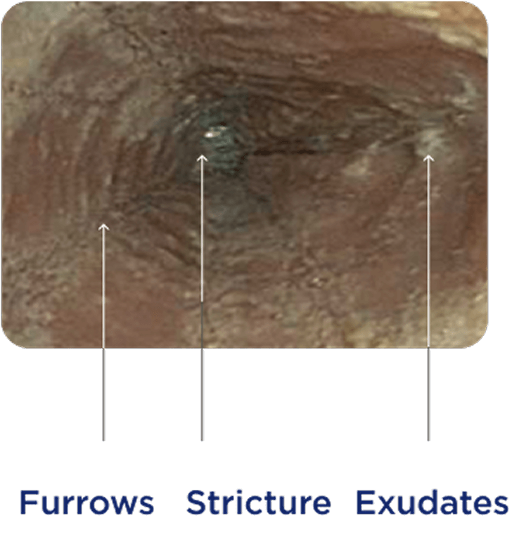 Endoscopic view of an inflamed esophagus showing esophageal furrows, structure, and exudates